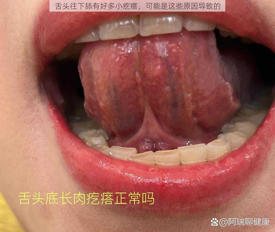 舌头往下舔有好多小疙瘩，可能是这些原因导致的